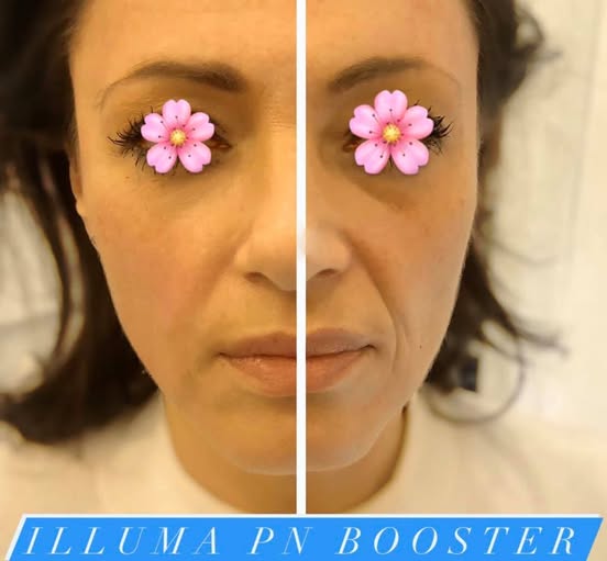 Before and after results using ILLUMA PN Booster – visible reduction of fine lines and skin texture improvement.