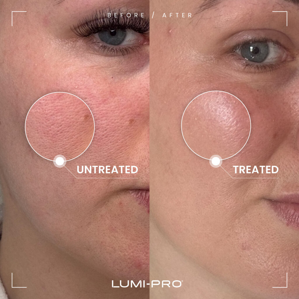 LUMI-PRO skin booster effect on enlarged pores – close-up of skin texture improvement after treatment