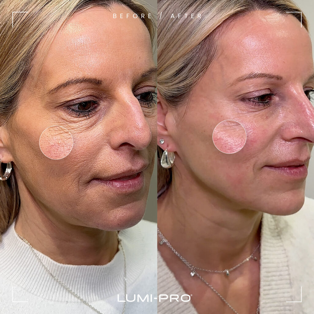 LUMI-PRO Skin Booster Before and After – visible wrinkle reduction and improved skin texture in mature woman after treatment